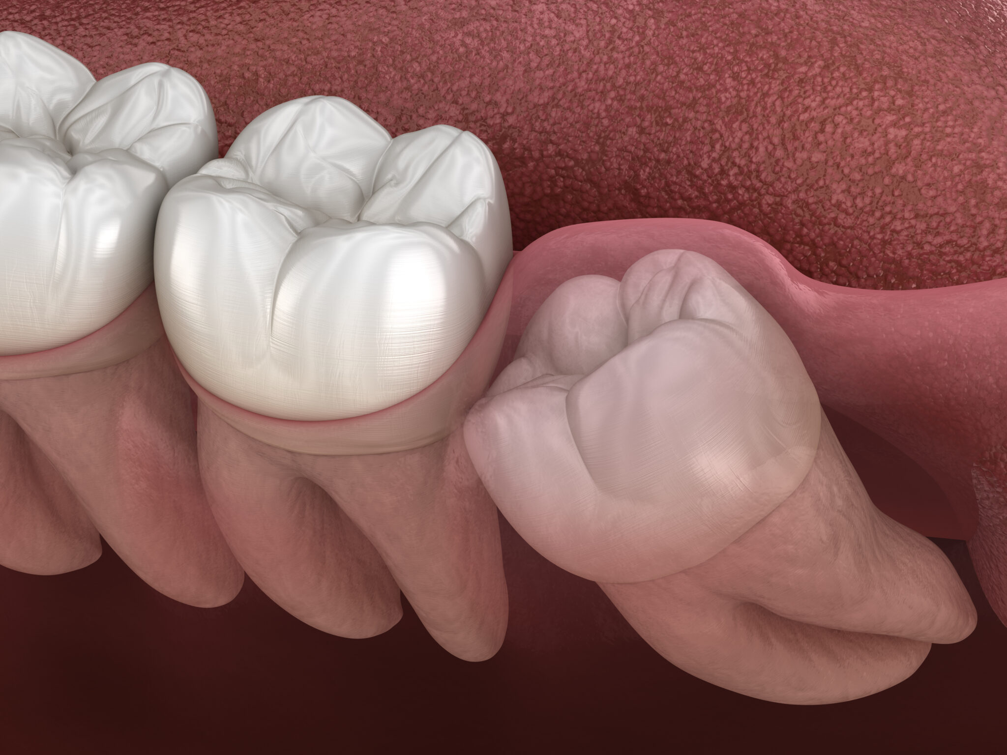 How to Care for an Erupted Wisdom Tooth Dental Concepts and Orthodontics